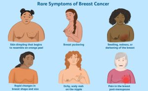 Rare symptoms of breast cancer