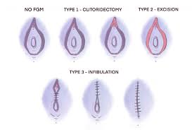 What mutilated female genitals look like