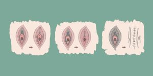 Types of female genital mutilation