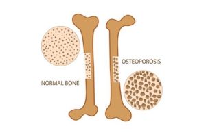 Normal bone vs bone with osteoporosis