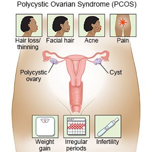 Symptoms of Polycystic Ovarian Syndrome 