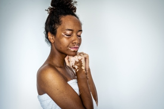 No, vitiligo is not a spiritual attack