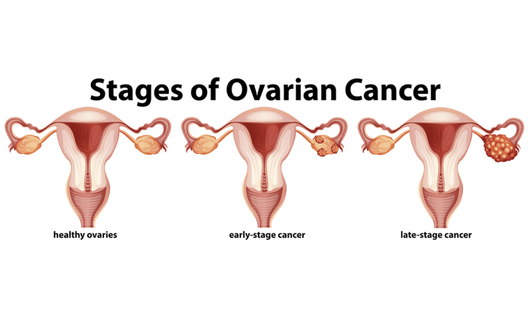 Stages of ovarian cancer