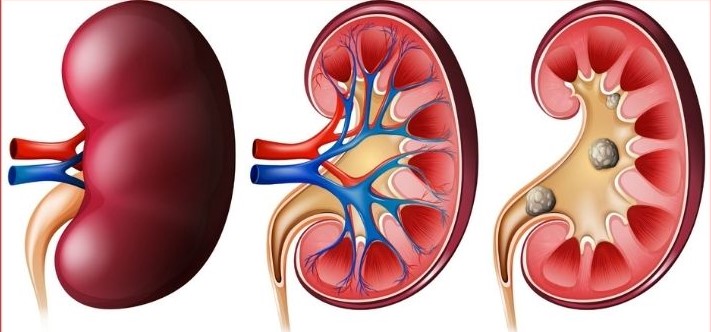 Health symptoms that signify presence of kidney stones