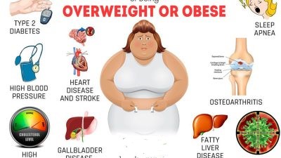 History of obesity increases risk of early death -Experts
