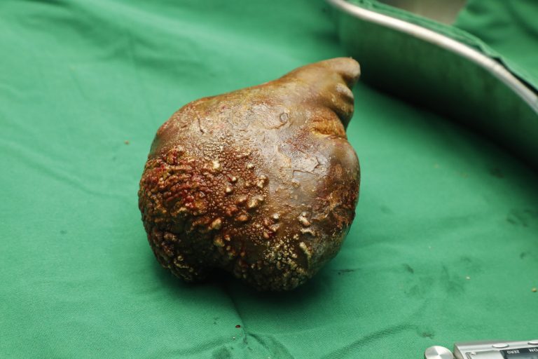 PHOTOS: Surgeons remove kidney stone larger than patient’s own kidney