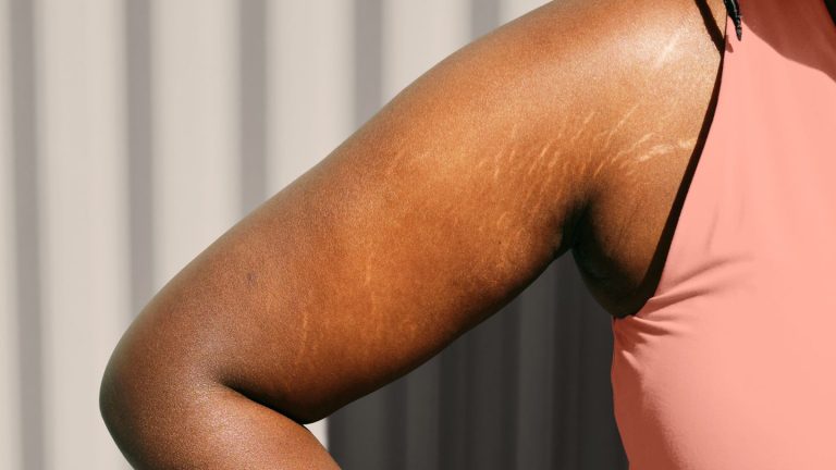 Say goodbye to stretch marks with these strategies