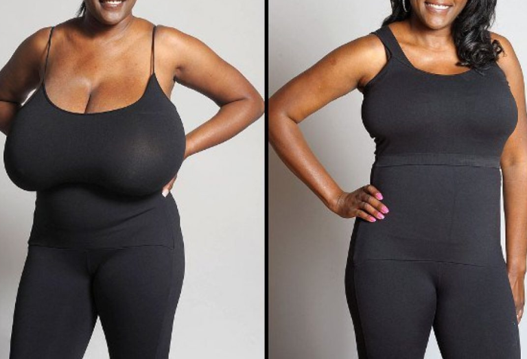 Breast reduction improved my life -Woman who says her large chest caused endless shoulder and back pain