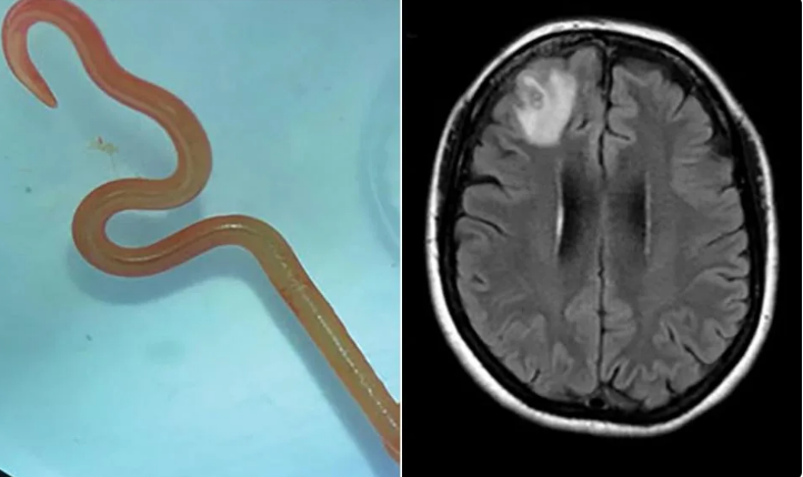 In world-first, doctors remove live worm from woman’s brain