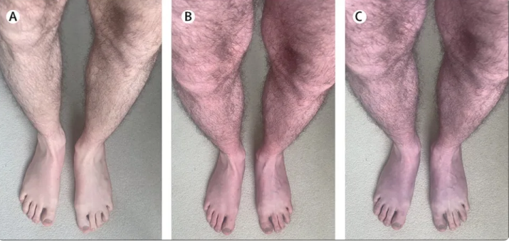 Covid-19 patient’s legs turn blue after 10 minutes of standing up