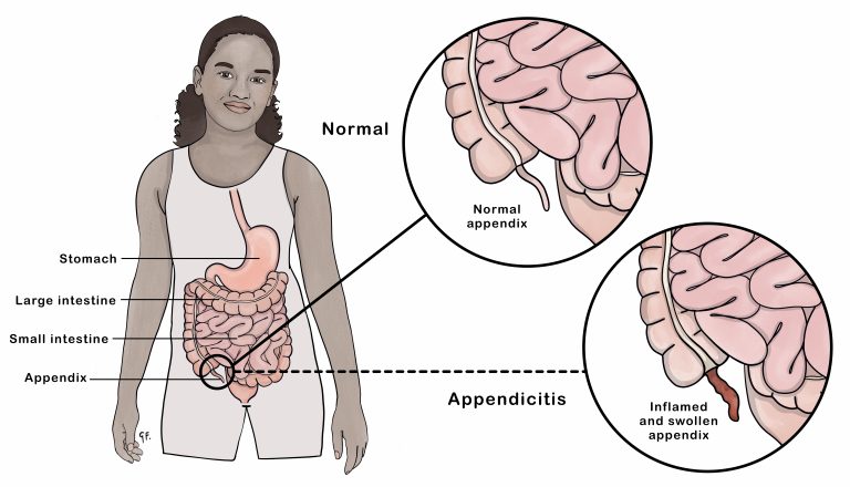 My wife died after doctors opened her up and then said they couldn’t do appendectomy because her appendix was covered by her intestines -Widower