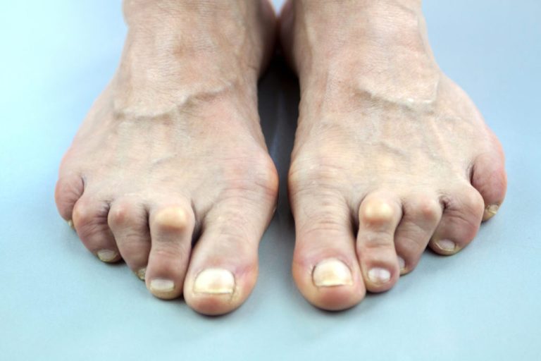 Why are your toes looking down?