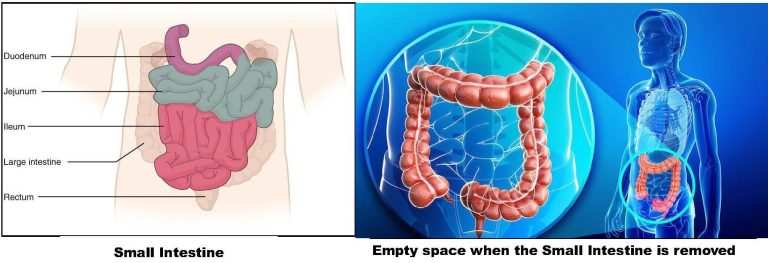 Adebola Akin-Bright: Parts of small intestine can be removed successfully by qualified surgeon –Retired physician