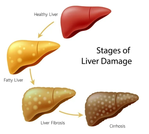 Don’t be a victim of fatty liver disease, the silent killer