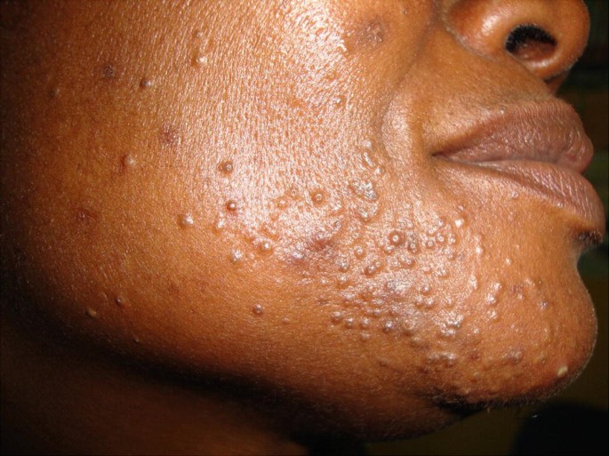 Comedonal acne: Causes, treatment, prevention