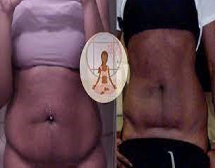 Managing loose skin after weight loss