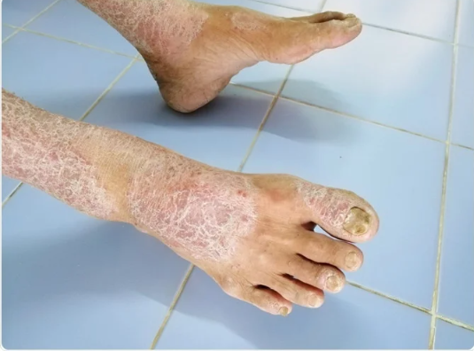 Unmasking scleroderma, a deadly skin disorder