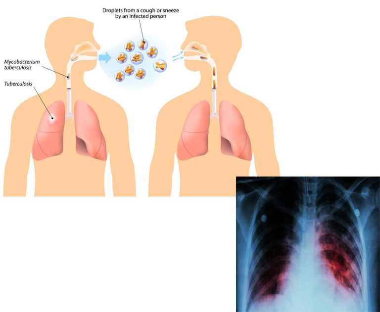 Tuberculosis kills, but you need not be a victim