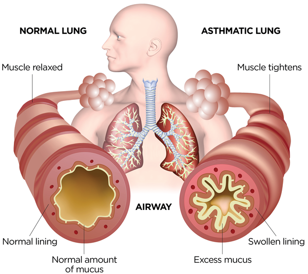 Asthmatic? Avoid these triggers