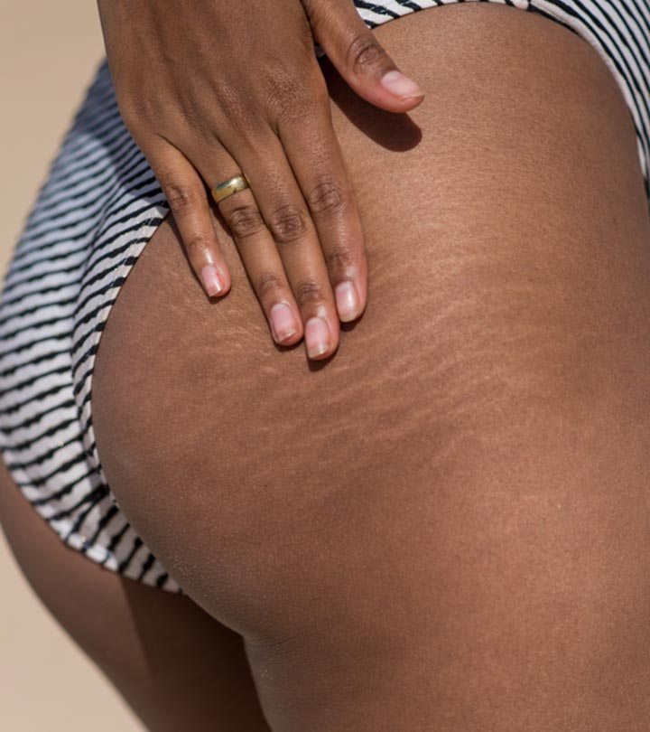 How to get rid of hyperpigmentation on buttocks