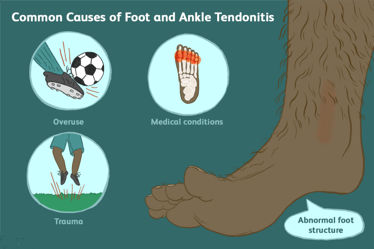 What is tendinitis?