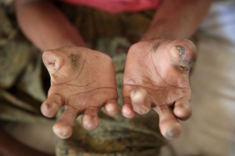 Leprosy still a major problem in Nigeria -Dermatologist