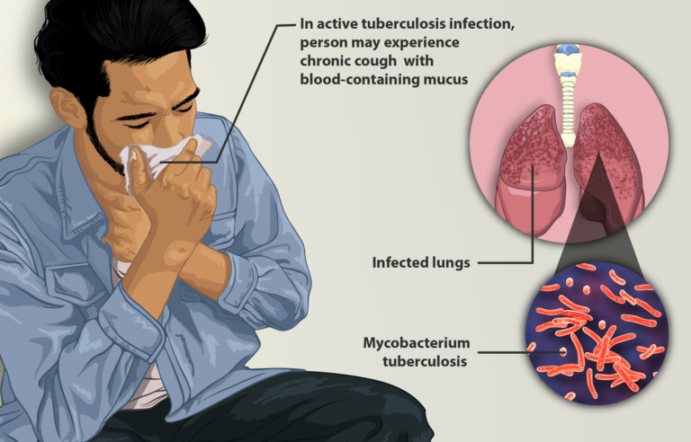 Borno risks lingering TB exposure as 10K patients shun treatment