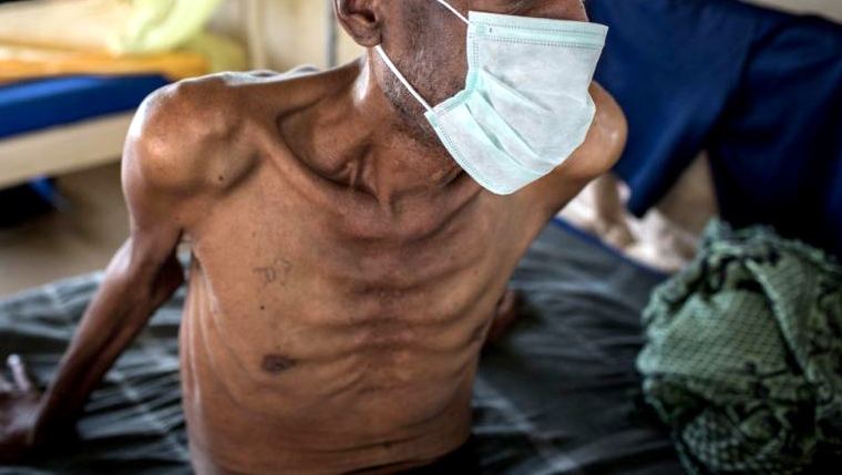 Undernutrition, HIV two top drivers of Nigeria’s TB burden