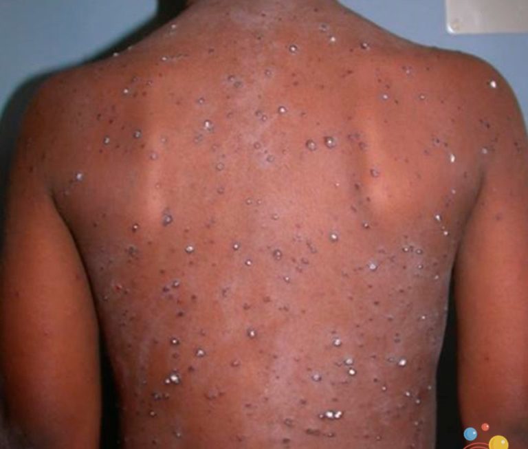This is the third chickenpox outbreak in Wukari -District Head