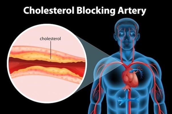 Blocked arteries? Here’s how to help yourself!