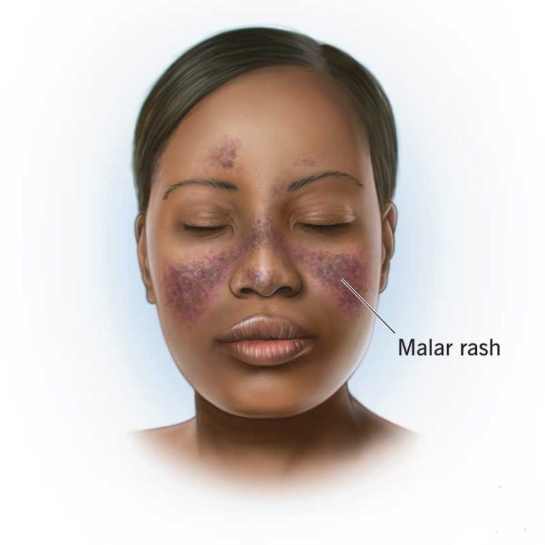 Beware, that facial rash, persistent fever, fatigue could be lupus