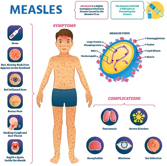 19 children die of measles complications in Adamawa