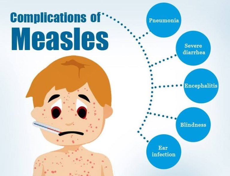 10 children die of suspected measles outbreak in FCT