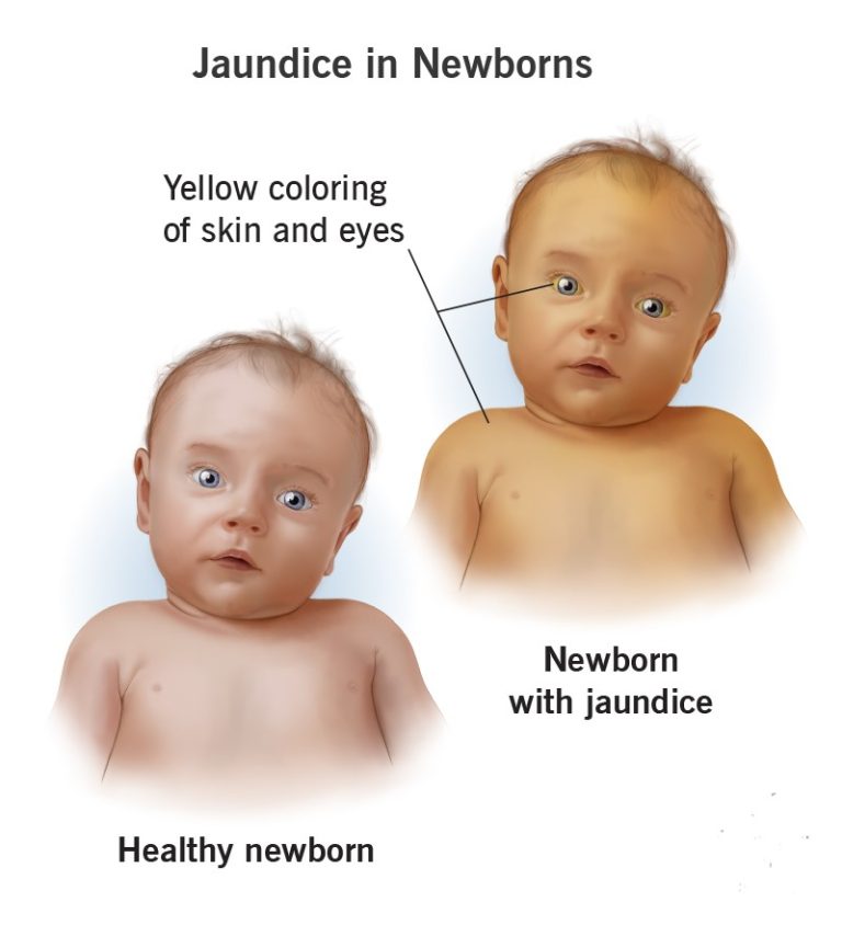 Breast milk not a cure for jaundice -Paediatrician