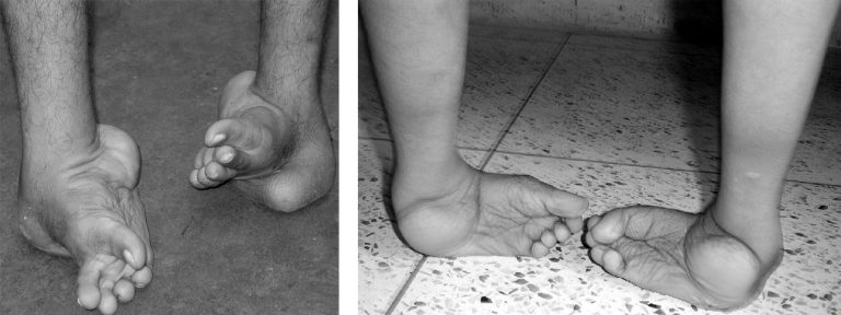 Most Nigerian children born with clubfoot lack access to treatment