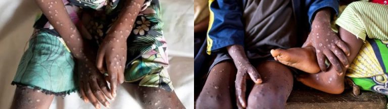 Africa to declare public health emergency over mpox