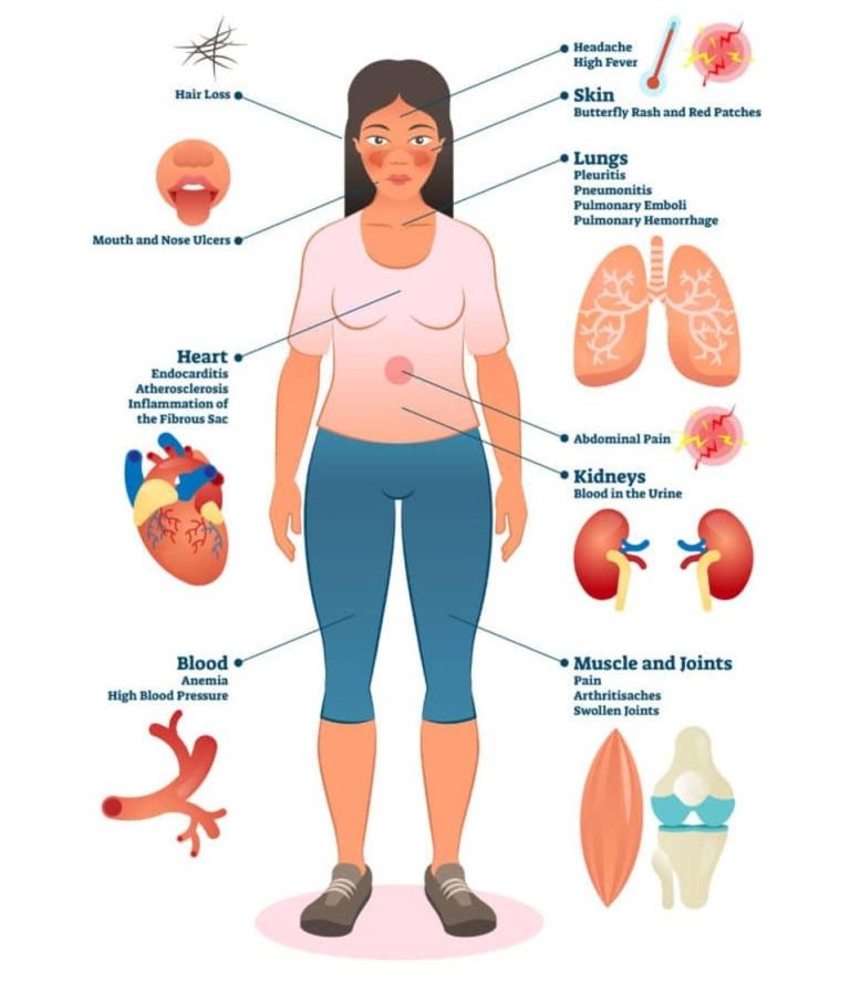 Understanding the connection between lupus and cancer