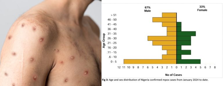 More males than females infected with mpox -CDC