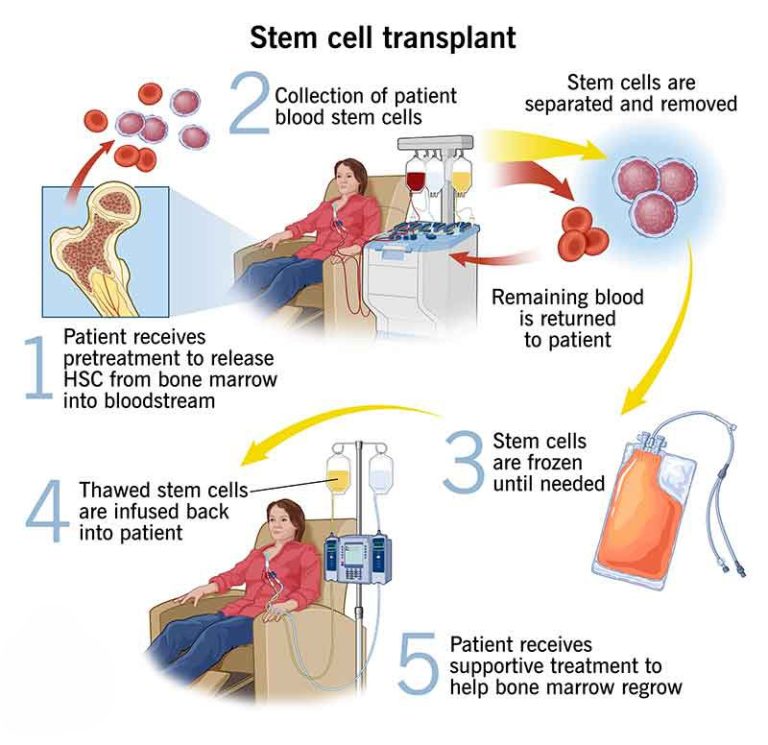 bone marrow transplant