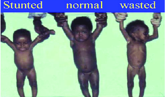 Wasting and stunting in children