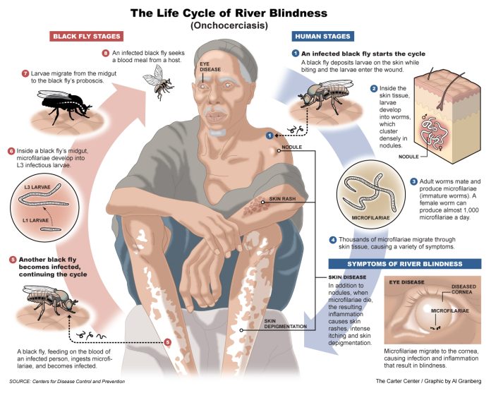 onchocerciasis