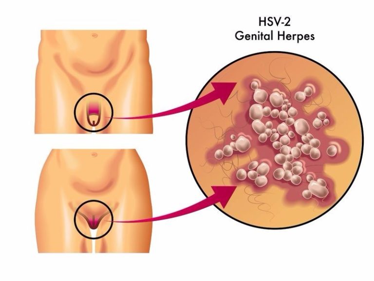 WHO reports global surge in genital herpes infections