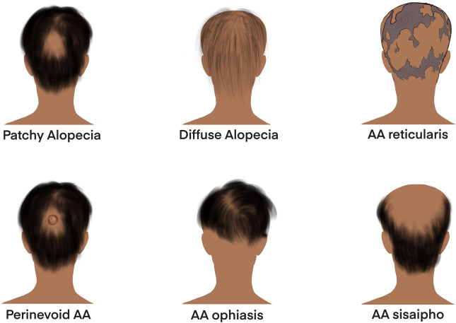 Alopecia or hair loss