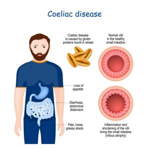 Coeliac Disease Symptoms