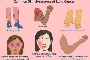 Common symptoms of lung cancer on the skin