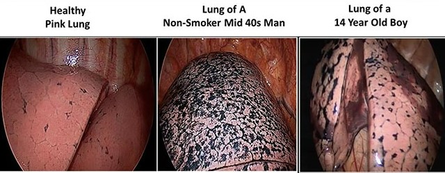 Diseased lung