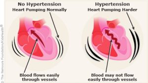 hypertensive heart