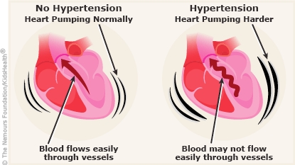 hypertensive heart