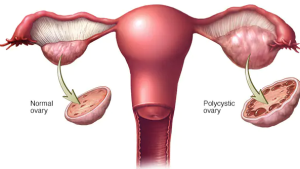 Polycystic Ovarian Cyst