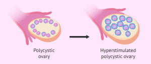 Ovarian Hyperstimulation Syndrome with PCOS